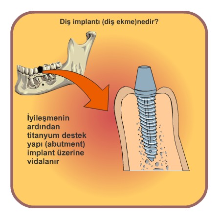 implant